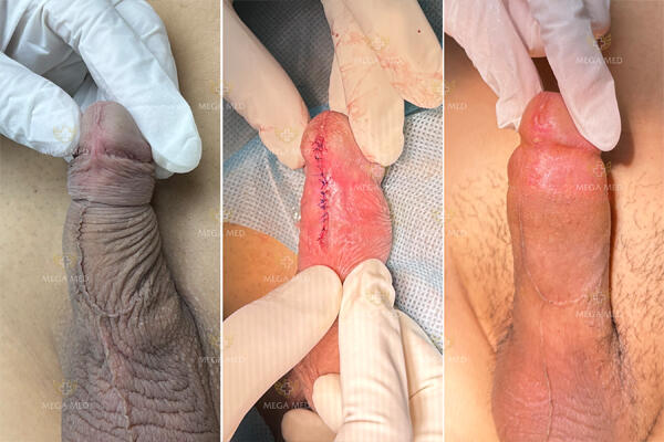 Tạo hình chỉnh ngắn dây hãm bao quy đầu